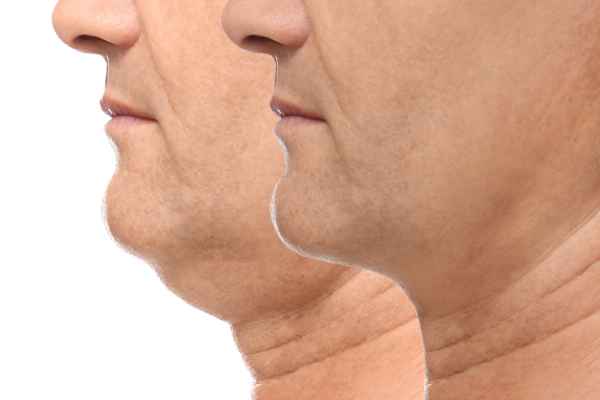 HIFU - Breakthrough in Anti - ageing 2 hifu results Lutterworth