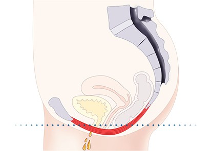 Pelvic-Floor Muscle Repair 5 Pelvic floor muscles Lutterworth
