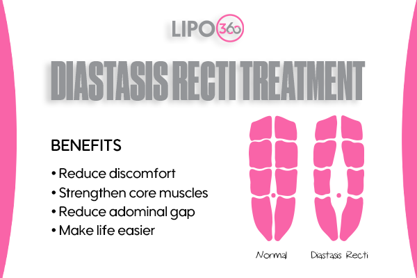 Revolutionising Muscle Repair: The Power of LIPO360 Body Sculpt Post-Injury 5 diastasis recti treatment Lutterworth