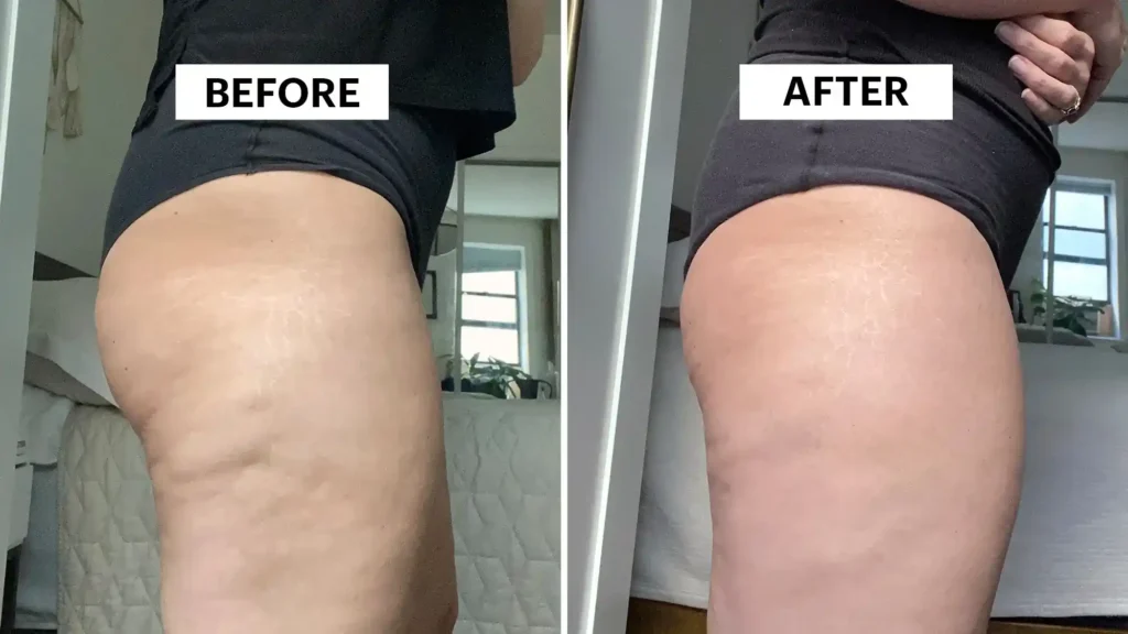 Do Toning Exercise Lutterworth Really Tackle Cellulite?