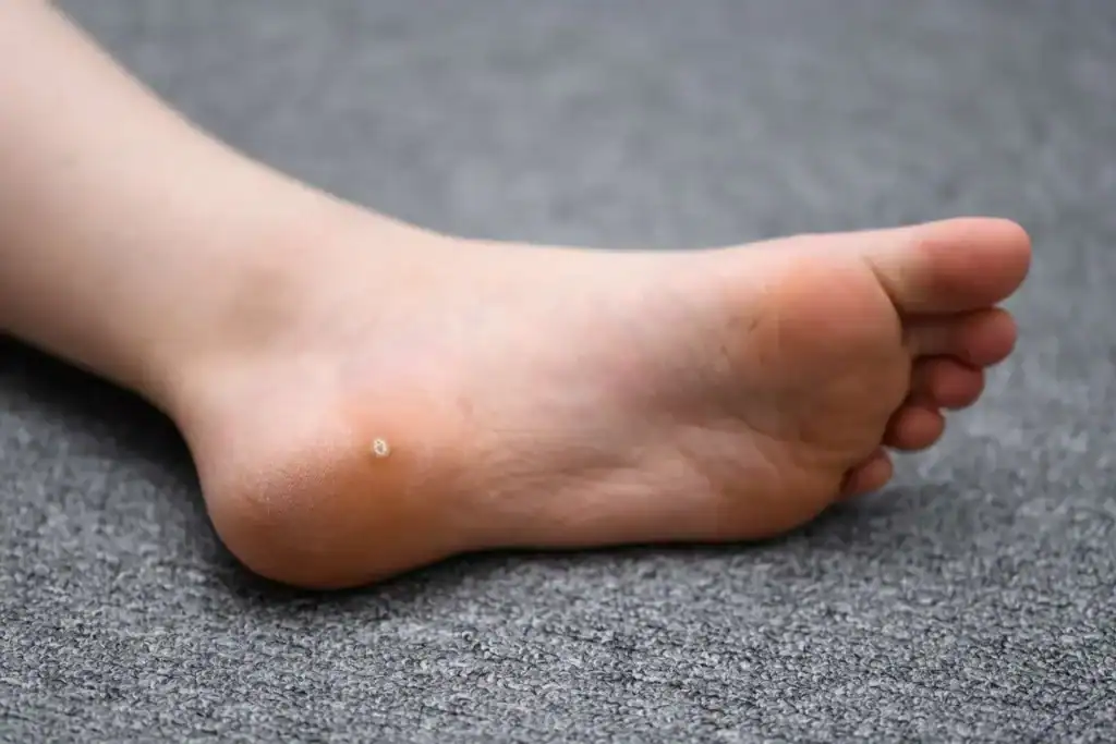 Cryotherapy For Warts And Also Verrucas 2 Image of verruca on the bottom of the foot that able to be treated with Cryotherapy Lutterworth