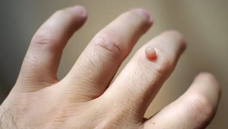 Image of blemish that Cryotherapy Lutterworth can remove with Lipo 360.