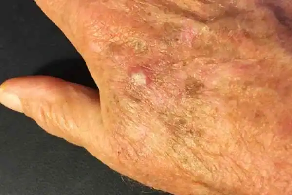Image of Actinic keratoses Lutterworth on a person hand