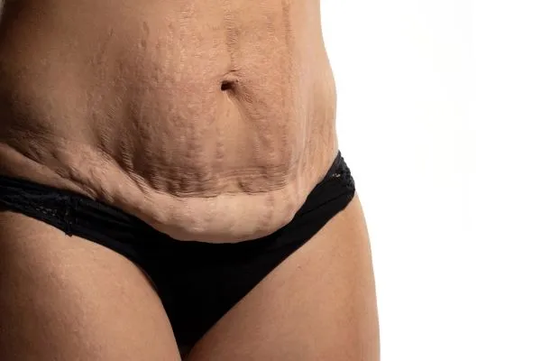 The Science of Skin Tightening 1 The science behind skin tightening Lutterworth picture of a woman's sagging skin on the stomach